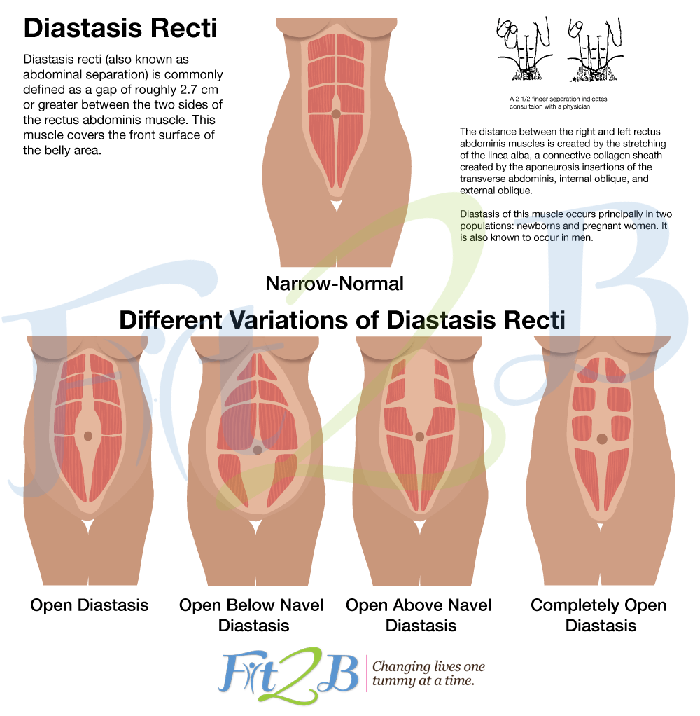 Diastasis recti 2025 belly band