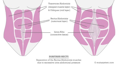 Babybellyband maternity supports diastasis recti during pregnancy