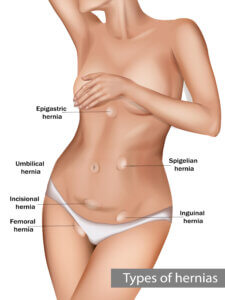 Types of abdominal hernias CABEA