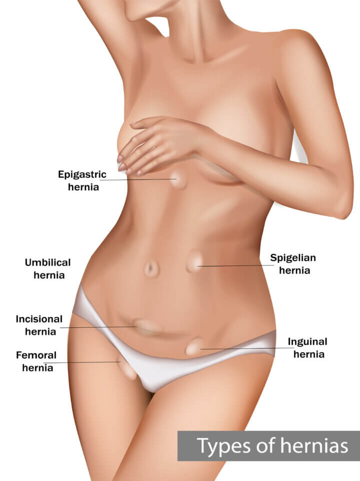 Types of abdominal hernias Types of abdominal hernias CABEA
