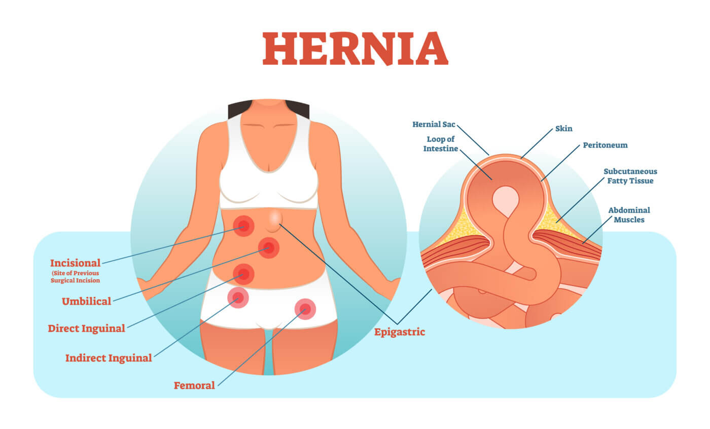 Types of hernias -inguinal-femoral-incisional and where they are locate-inguinal hernia is in the groin area