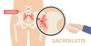 Sacroiliac joint in pelvis inflamed with sacroiliac joint issue sacroiliitis