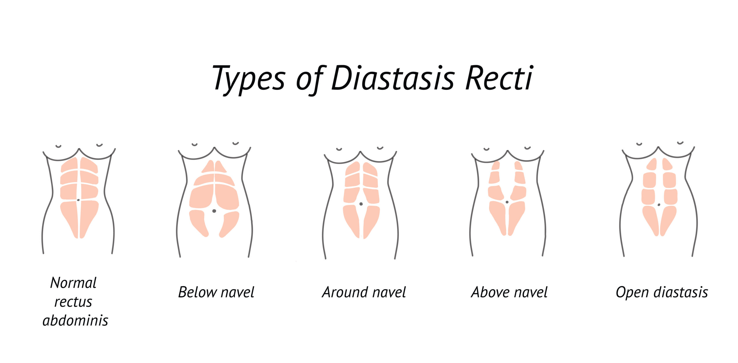 Postpartum Recovery Support Wrap For Diastasis Recti